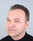 Before Hair Transplant&nbsp;Temporal Hairline